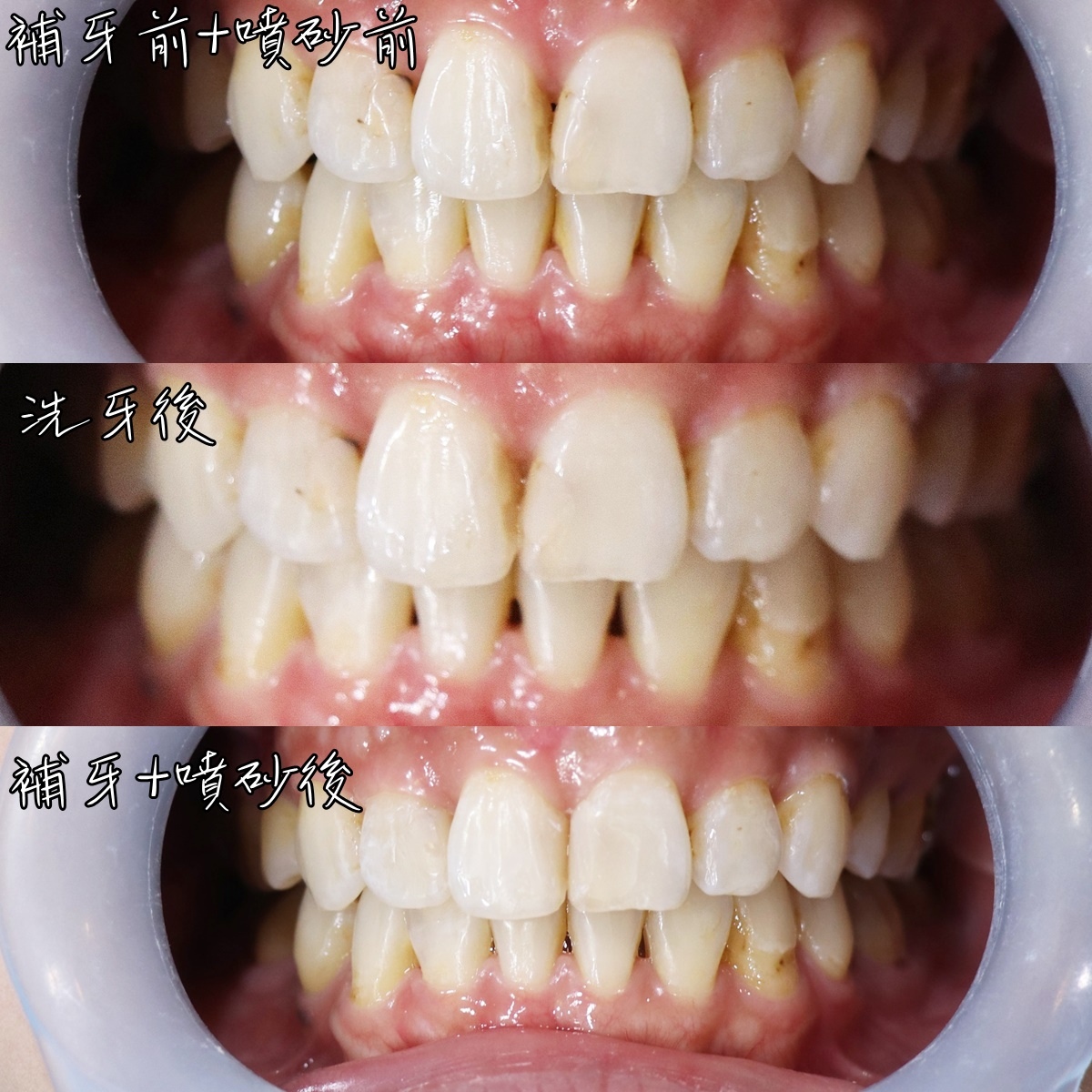 左營噴砂美白心得:術前術後比較圖