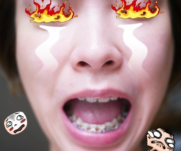 一年八個月的牙套心得～痠又來找我了